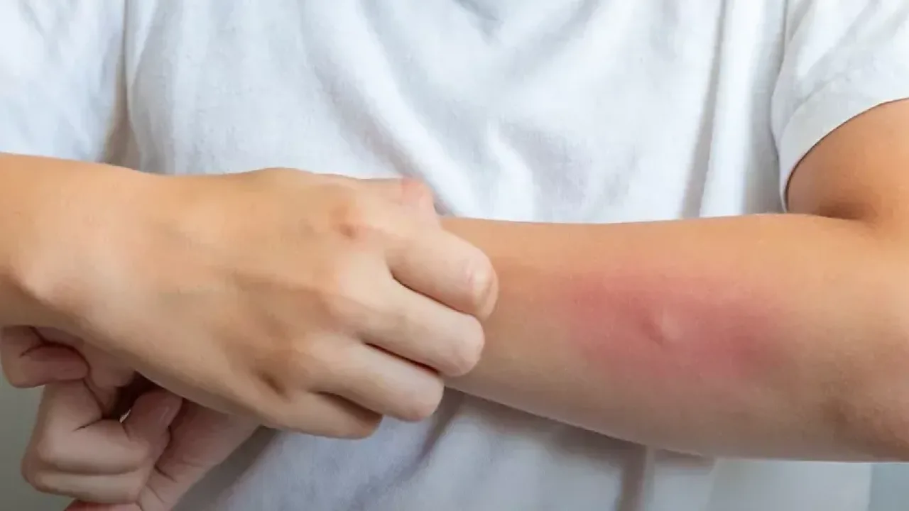 Egzama yalnızca cildi değil, sosyal yaşamı da etkileyebiliyor