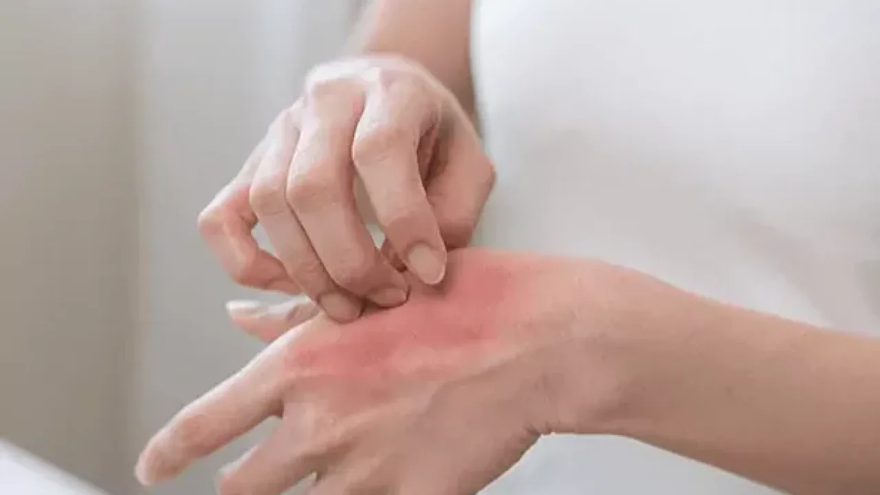 Kaşıntı yalnızca bir cilt sorunu olarak ele alınmamalı!